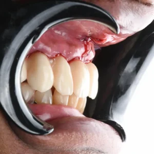 edenté complet Mr.B - OMDA