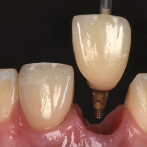 Implant OMDA