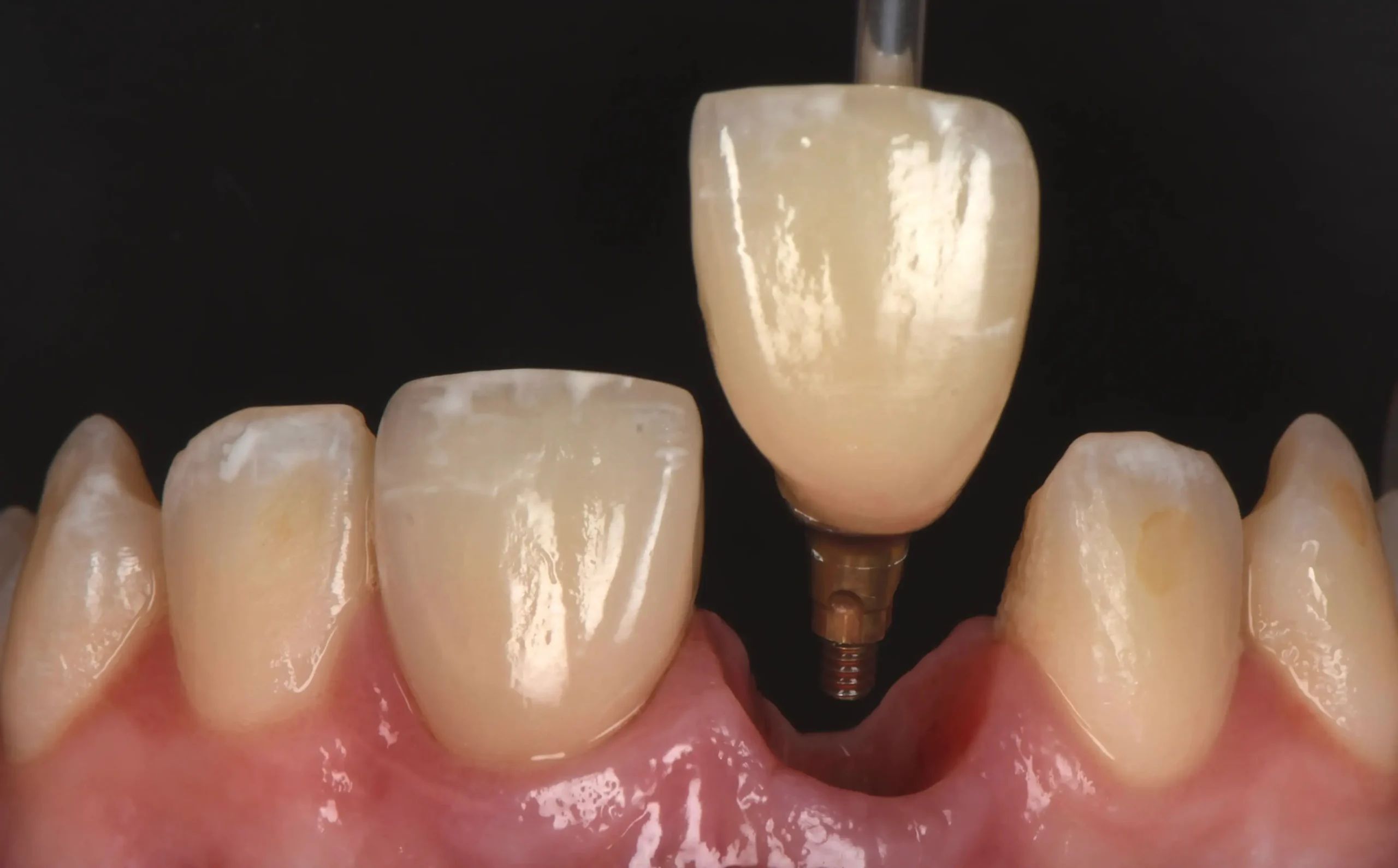 Implant OMDA